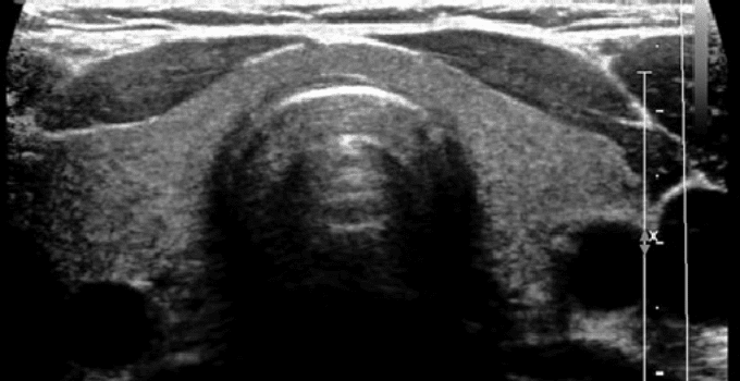 tiroid ultrasonu