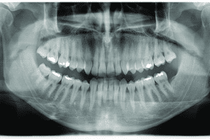 diş röntgeni panoramik fiyatları