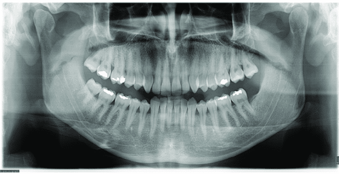 diş röntgeni panoramik fiyatları