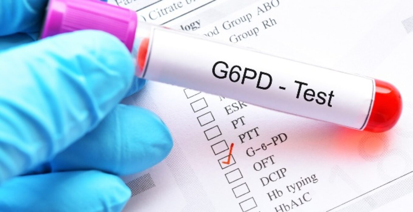 Glukoz6fosfat dehidrogenaz G6PD Testi Emar Tomografi
