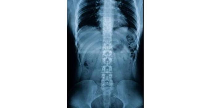 omurga röntgeni ücreti