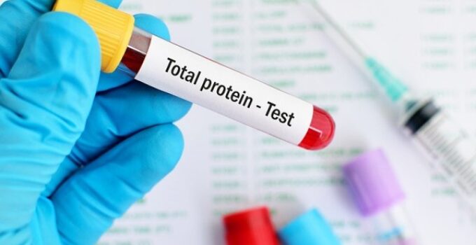 total protein testi ücreti