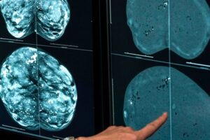 mamografi ne zaman yapılmalı