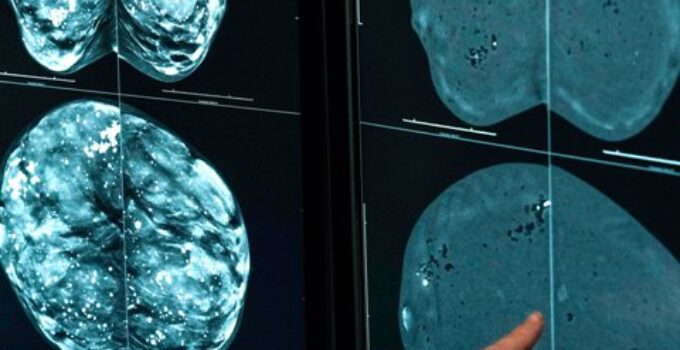 mamografi ne zaman yapılmalı